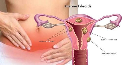 Symptoms of Uterine Fibroids