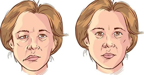 Anesthesia in endoscopic neurosurgery for facial paralysis