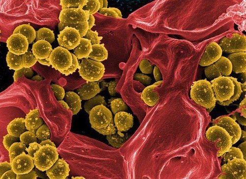 
Staphylococcus aureus is one of the common agents in pediatric lung abscesses
