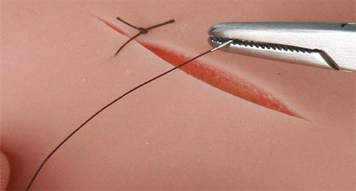 
For injuries to the genital tract, the perineum or tears in the genital tract will be sewn up with absorbable sutures
