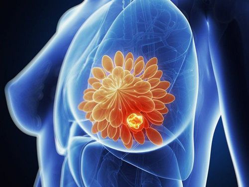 What is breast cancer screening?