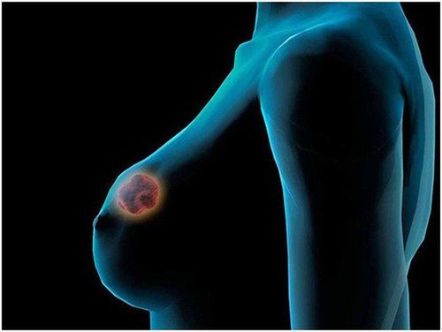 Interpretation of terms in pathologic findings for breast cancer