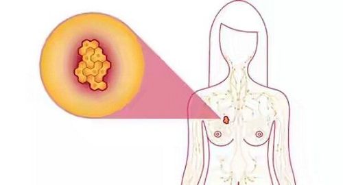 Breast cancer: Causes and symptoms