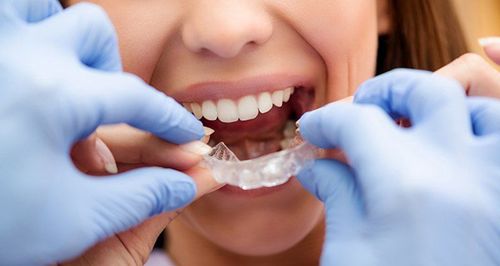 Vai trò của máng chống nghiến răng