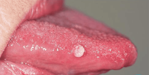 How to treat warts under the tongue?