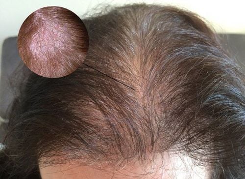 Is scalp psoriasis contagious with no treatment?