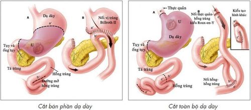 Cắt dạ dày được chỉ định trong trường hợp nào?