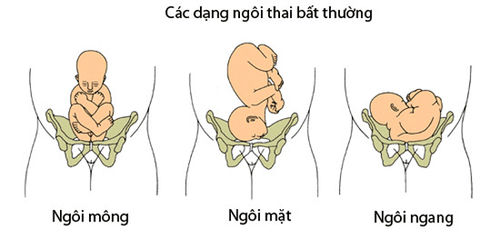 
Thai nhi bị ngôi thai bất thường phát sinh trong thai kỳ
