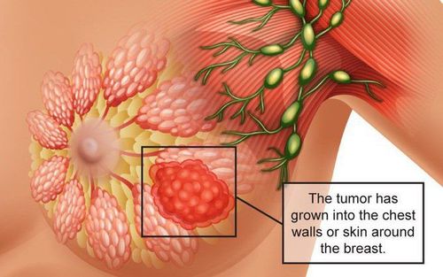 
U diệp thể vú có hình dạng giống như một chiếc lá
