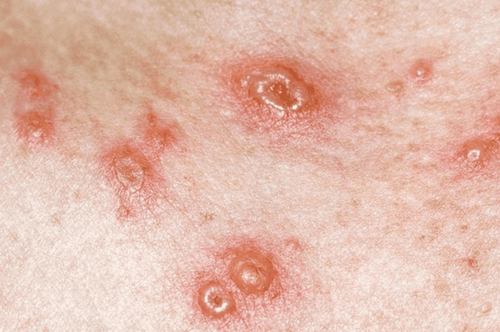 Scratching a lot, abstaining from bathing can cause skin infections in people with chickenpox