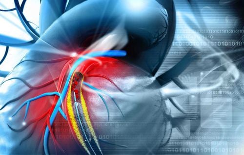 How does coronary calcification occur?