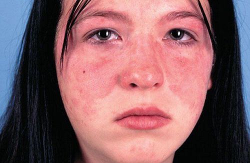 
Lupus gây các vấn đề về khô mắt
