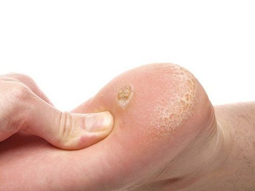 Learn about warts or plantar warts