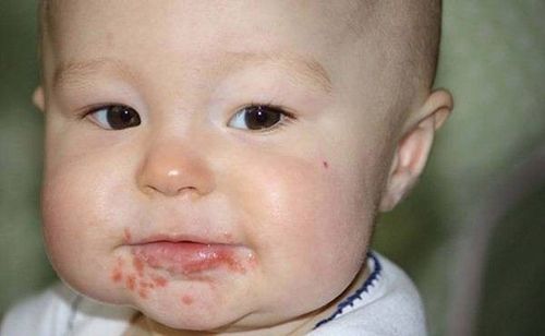 Hand, foot and mouth disease incubation period and spread