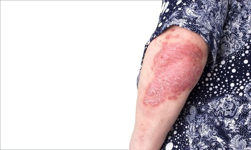 Psoriasis should eat like?