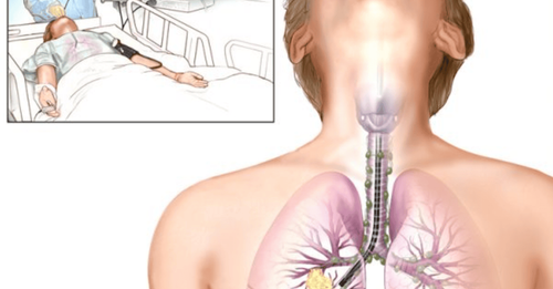 The role of bronchoscopy in the diagnosis of respiratory diseases