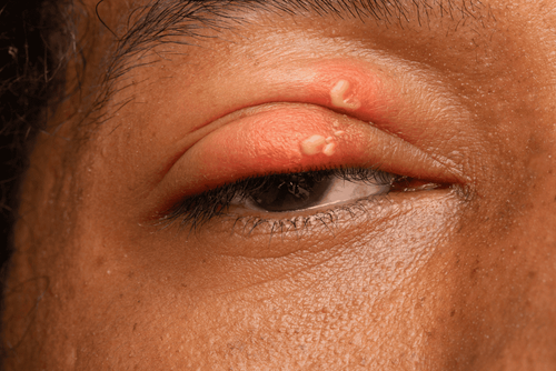 How to get shingles in the eye?