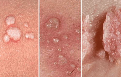 Burn warts with high frequency waves