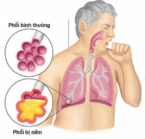 
Nhiễm trùng nấm Aspergilloma ở phổi
