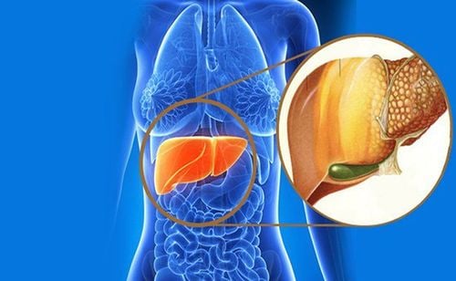 Who is more likely to get nonalcoholic fatty liver disease?
