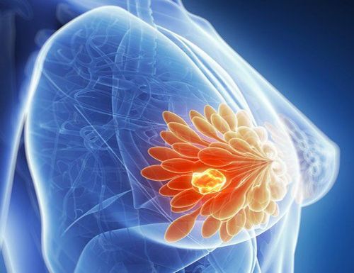 What is breast cancer and is it dangerous?