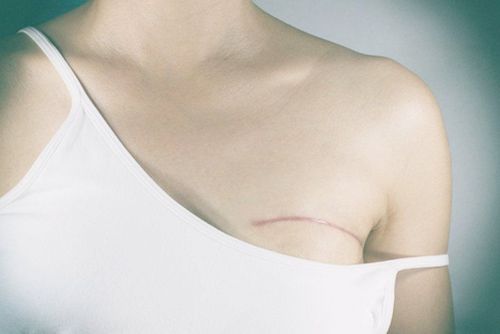 Learn about atypical breast hyperplasia