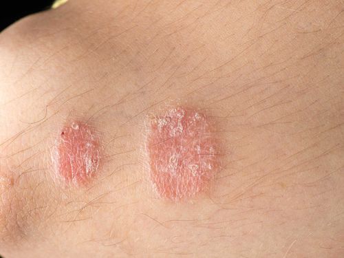 Causes of Psoriasis