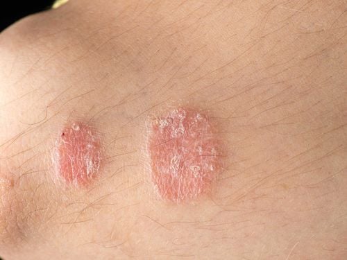 What is psoriasis? All you need to know about psoriasis