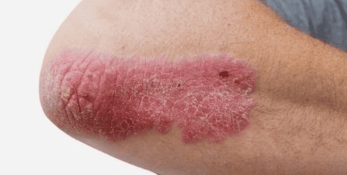 Winter care tips for psoriasis