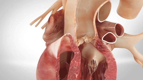 Overview of aortic dissection