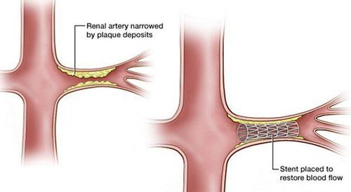 
Phương pháp đặt stent động mạch thận khắc phục hẹp động mạch
