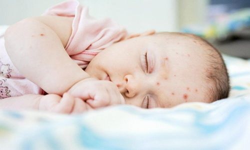 Nhận biết nhiễm trùng da ở trẻ sơ sinh