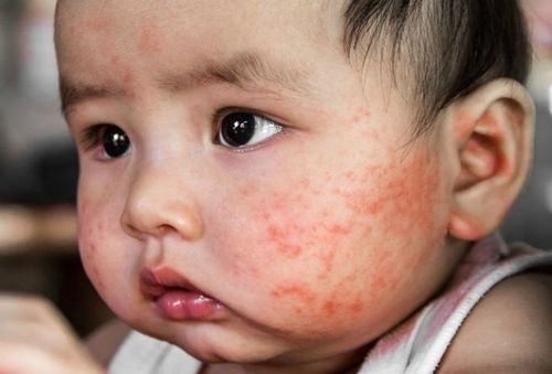 Hình ảnh trẻ sơ sinh bị viêm da dị ứng