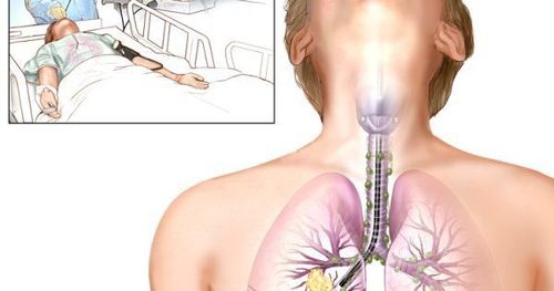 Procedure and possible risks during bronchoscopy