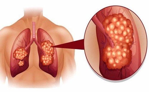 Ung thư phổi đã di căn có thể áp dụng cách chữa bệnh tự thân không?