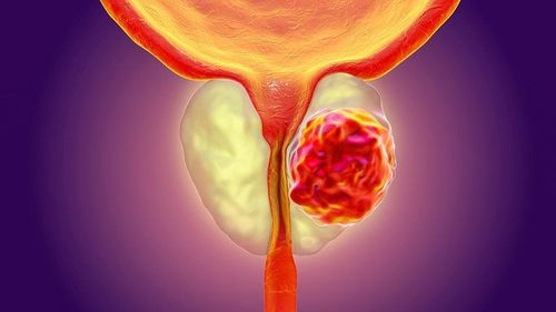 Treatment of prostate calcification