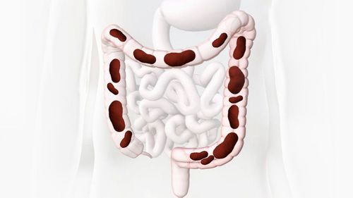 Enema to prepare colon clean before ultrasound, colonoscopy