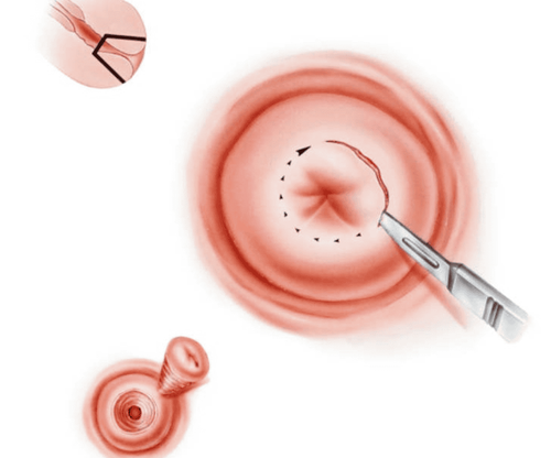 Obstetric risks after cervicectomy