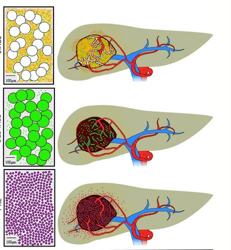 Background digitized liver angiography procedure