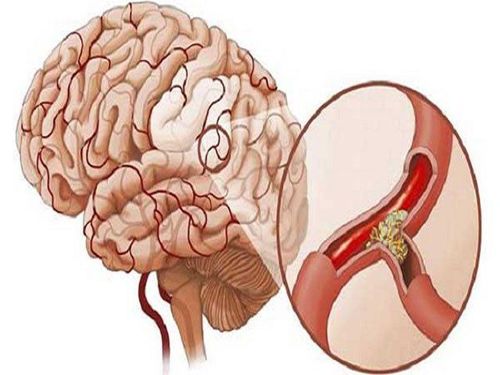 
Bệnh nhân nhồi máu não có thể xảy ra do xơ vữa mạch máu
