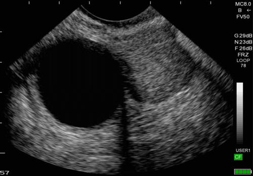 Note that ovarian cysts ruptured during treatment