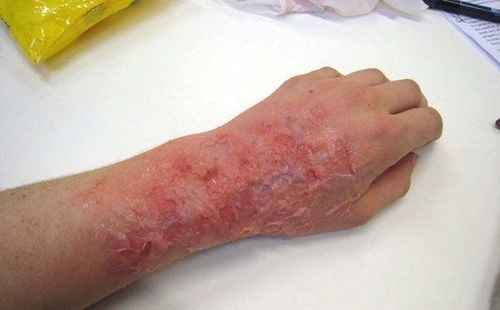 Manifestations of infection and poisoning burns