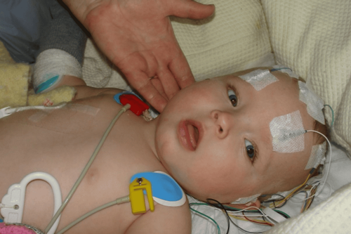 Cerebral hemorrhage - premature membranes in young children