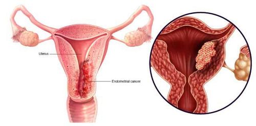 Các định hướng điều trị ung thư niêm mạc tử cung