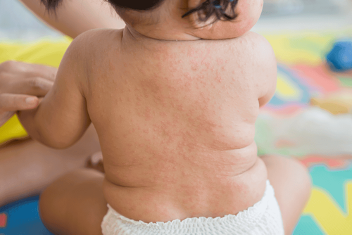 Bé phát ban rải rác trên da sau khi tiêm vắc-xin Sởi-Quai bị-Rubella chăm sóc thế nào?
