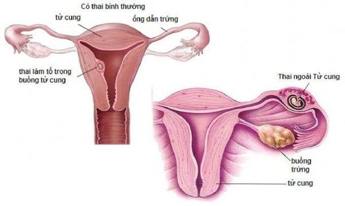 
Dính buồng tử cung là nguyên nhân dẫn đến lớp niêm mạc tử cung mỏng
