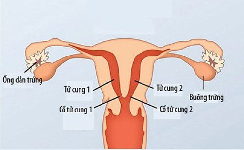 
Phụ nữ có tử cung có vách ngăn thường khó mang thai
