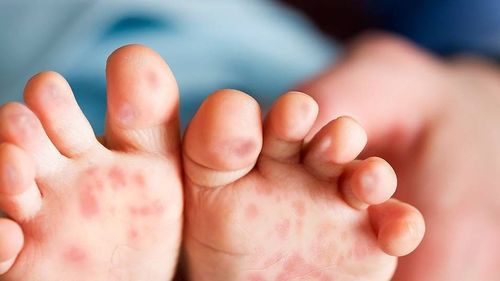 Beware of hand, foot and mouth disease, dengue fever in the season