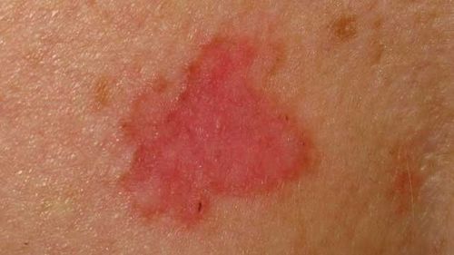 Basal cell carcinoma: Diagnosis and treatment