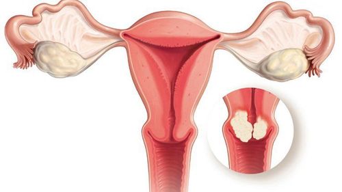 
Cắt tử cung qua đường âm đạo không để lại sẹo như mổ nội soi và mổ bụng
